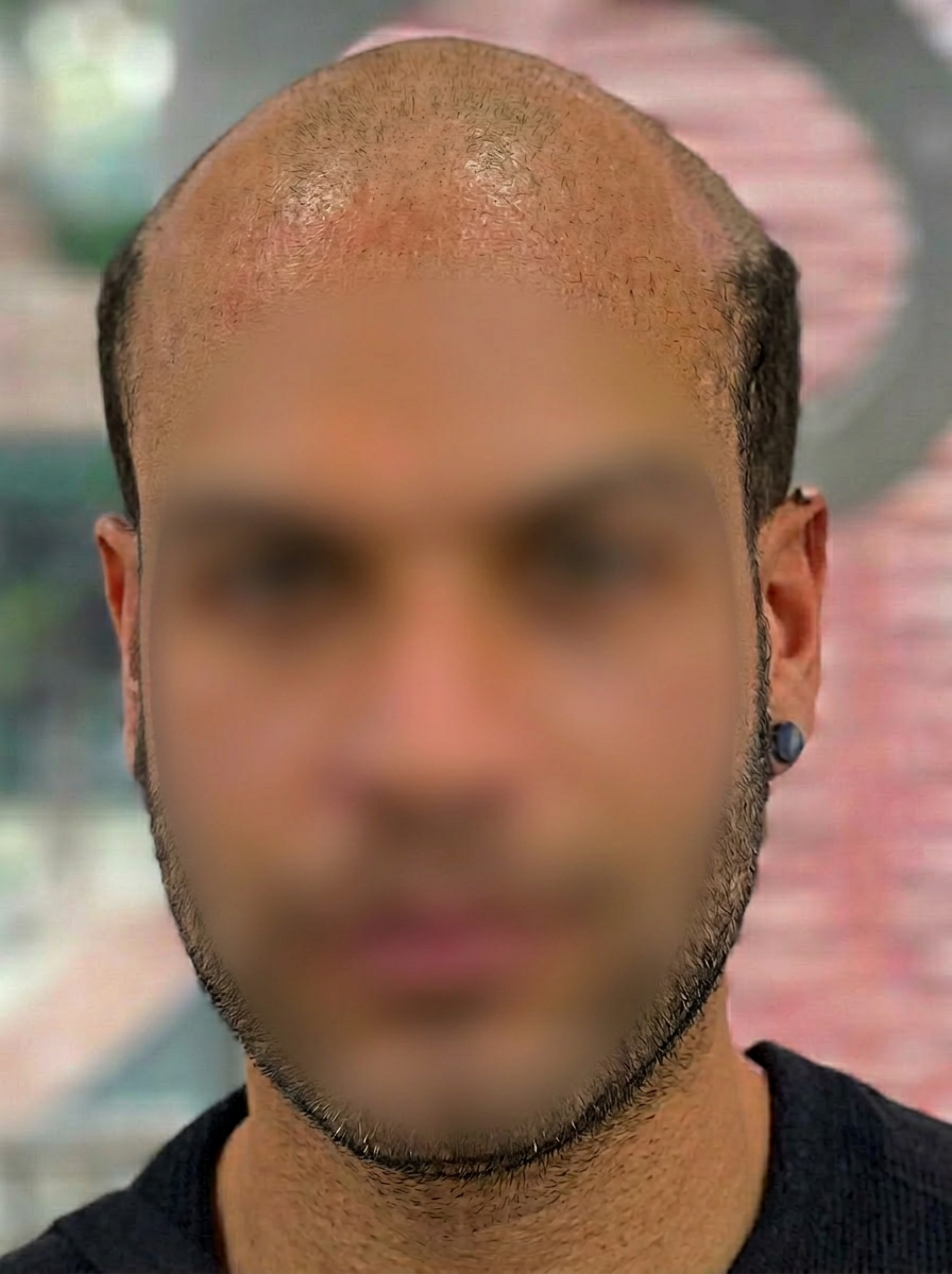 Πριν την εφαρμογή hair system