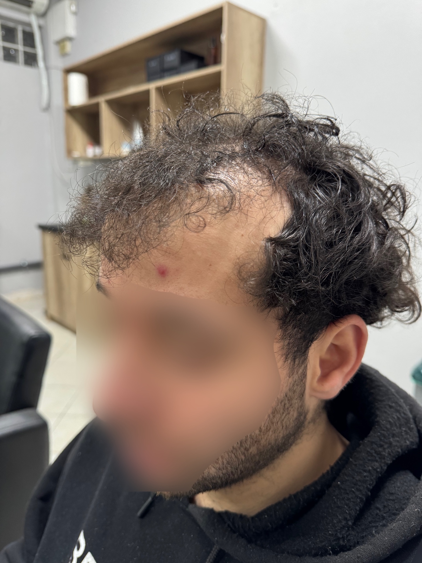 Πριν το νέο hair system