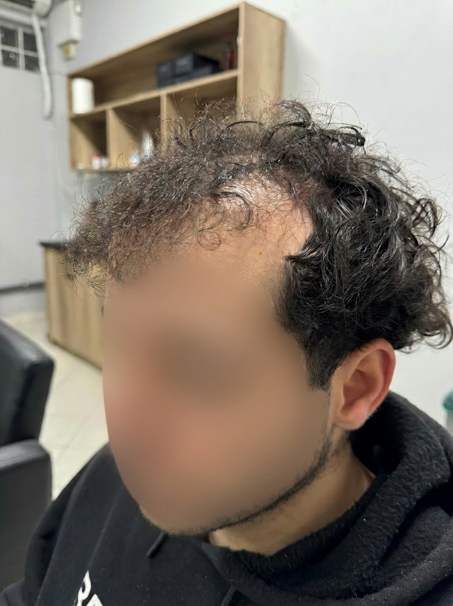 Πριν το curly hair system